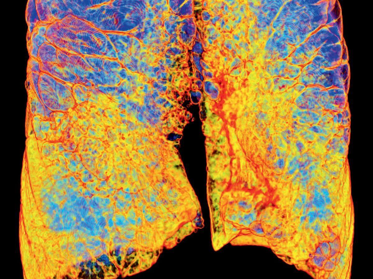 Poumons : BPCO, l'épidémie silencieuse Poumons : BPCO, l'épidémie silencieuse