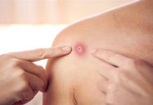 جدري القرود؛ الأعراض وطرق الوقاية بعد اكتشاف أول حالة في مصر جدري القرود؛ الأعراض وطرق الوقاية بعد اكتشاف أول حالة في مصر