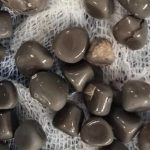 استخراج 58 حصوة من كلية مريض في مصر استخراج 58 حصوة من كلية مريض في مصر