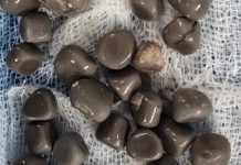 استخراج 58 حصوة من كلية مريض في مصر استخراج 58 حصوة من كلية مريض في مصر