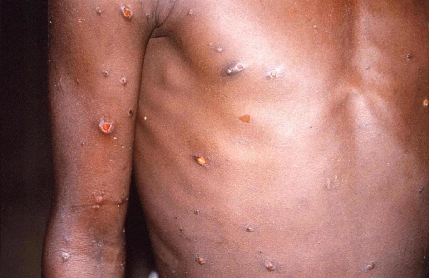 Monkeypox cases surge as WHO stops short of declaring a global emergency Monkeypox cases surge as WHO stops short of declaring a global emergency