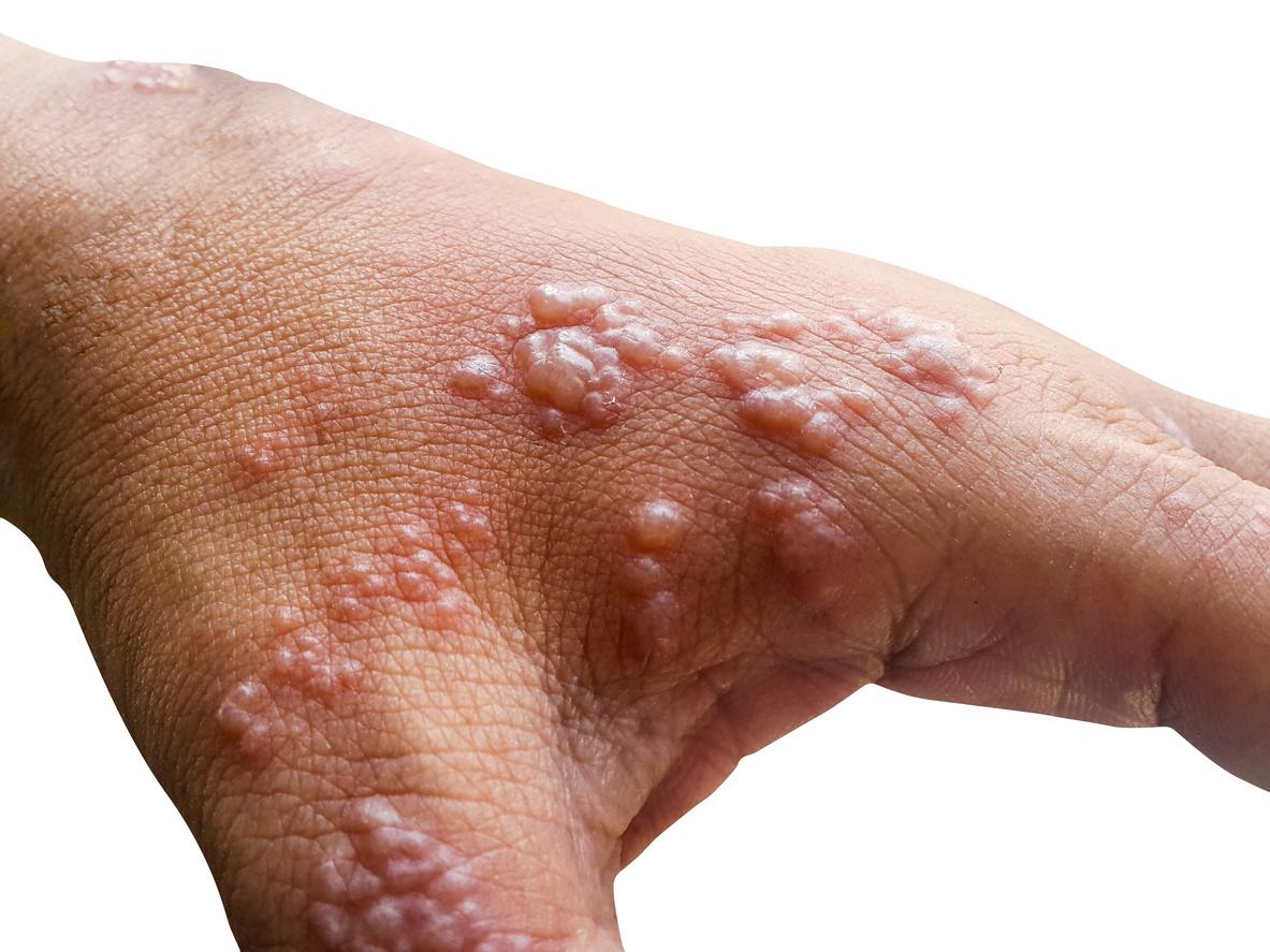 Monkeypox: African Union warns of rising cases Monkeypox: African Union warns of rising cases