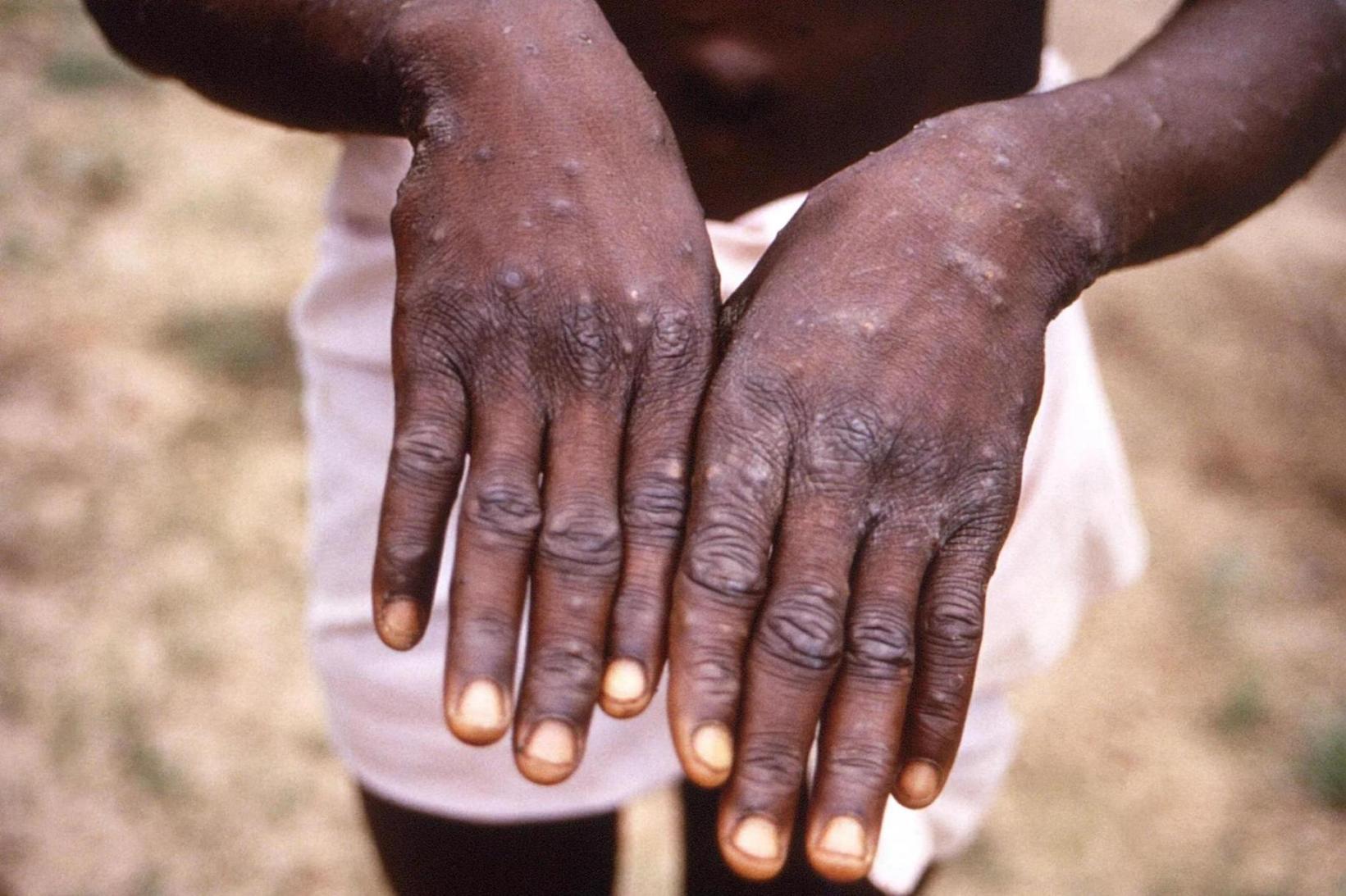 Monkeypox cases top 70,000: WHO Monkeypox cases top 70,000: WHO
