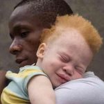 Albinism Stigma Myths and Ritualistic Fears Albinism Stigma Myths and Ritualistic Fears