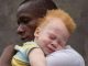 Albinism Stigma Myths and Ritualistic Fears Albinism Stigma Myths and Ritualistic Fears