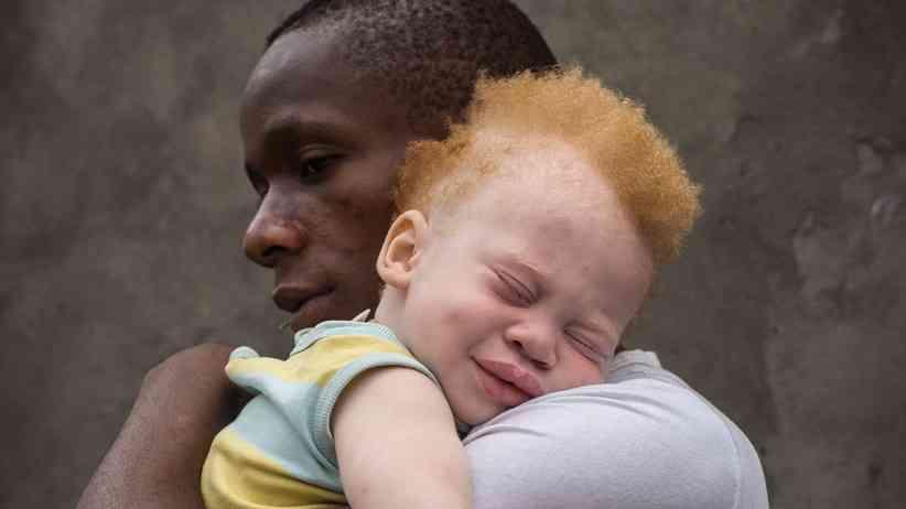Albinism Stigma Myths and Ritualistic Fears Albinism Stigma Myths and Ritualistic Fears