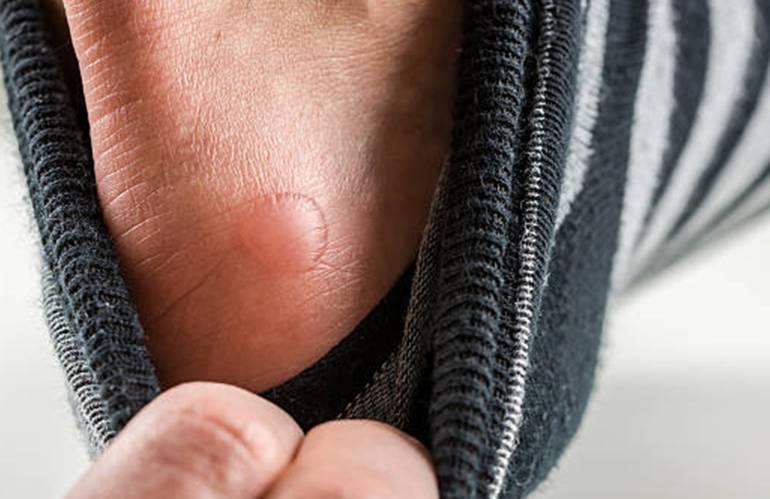 Bien-être : comment soigner les ampoules ? Bien-être : comment soigner les ampoules ?