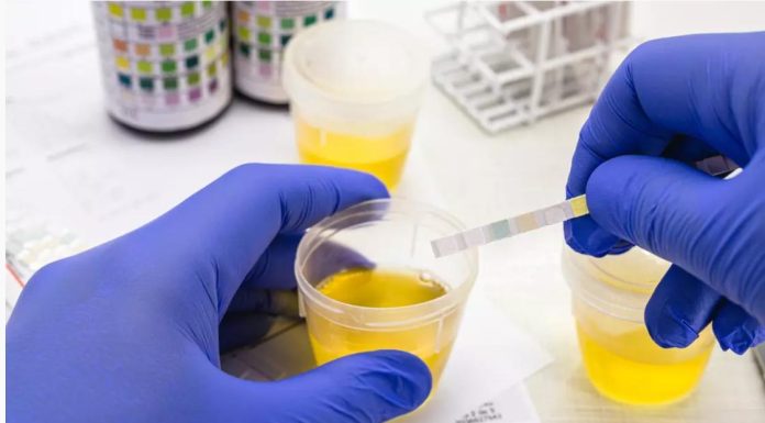 Glycosurie: Causes, Symptômes, Diagnostic et Prise en Charge Glycosurie: Causes, Symptômes, Diagnostic et Prise en Charge