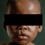 Opération Humanitaire Pour Réparer Visages D’Enfants Opération Humanitaire Pour Réparer Visages D'Enfants