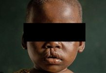 Opération Humanitaire Pour Réparer Visages D’Enfants Opération Humanitaire Pour Réparer Visages D'Enfants