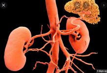 High blood pressure may be treated by burning nerves near the kidneys! High blood pressure may be treated by burning nerves near the kidneys!