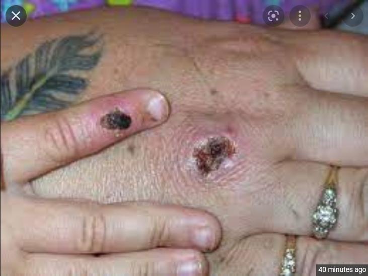 Here's how the US handled its first ever monkeypox outbreak that infected dozens of people across several states Here's how the US handled its first ever monkeypox outbreak that infected dozens of people across several states
