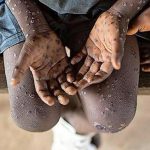 Moh Urges Public Vigilance over Mpox Case Moh Urges Public Vigilance over Mpox Case