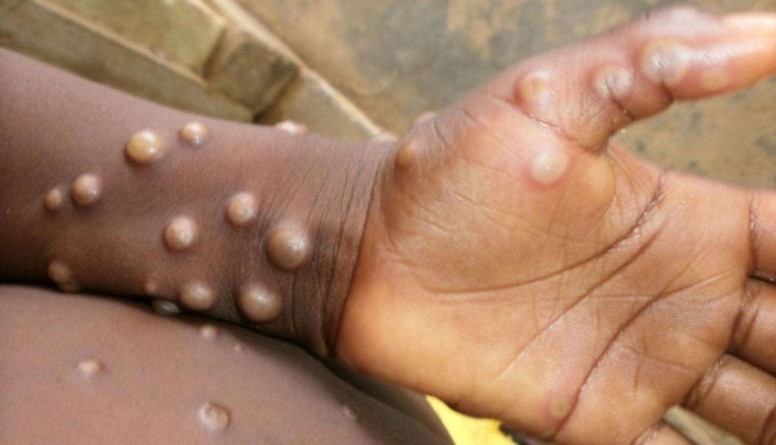 Mpox Outbreak Increase Vigilance at Points of Entry into Ghana