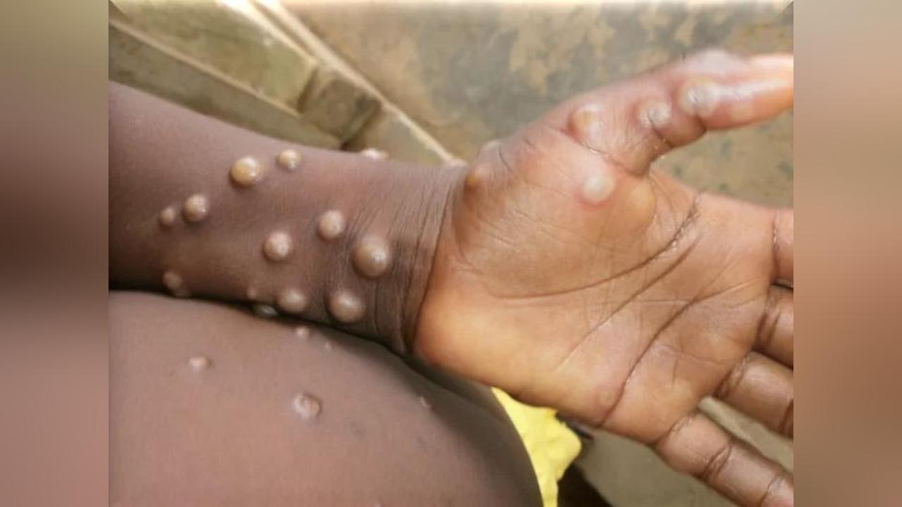 When Nature was not Enough: A Man’S Encounter with Mpox When Nature was not Enough: A Man’S Encounter with Mpox