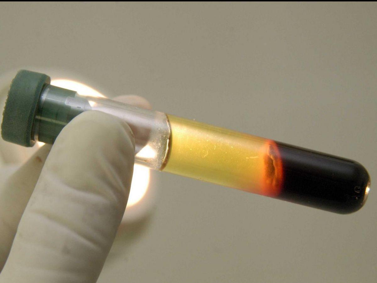 Accumulation du Mauvais Cholestérol dans le Sang Accumulation du Mauvais Cholestérol dans le Sang