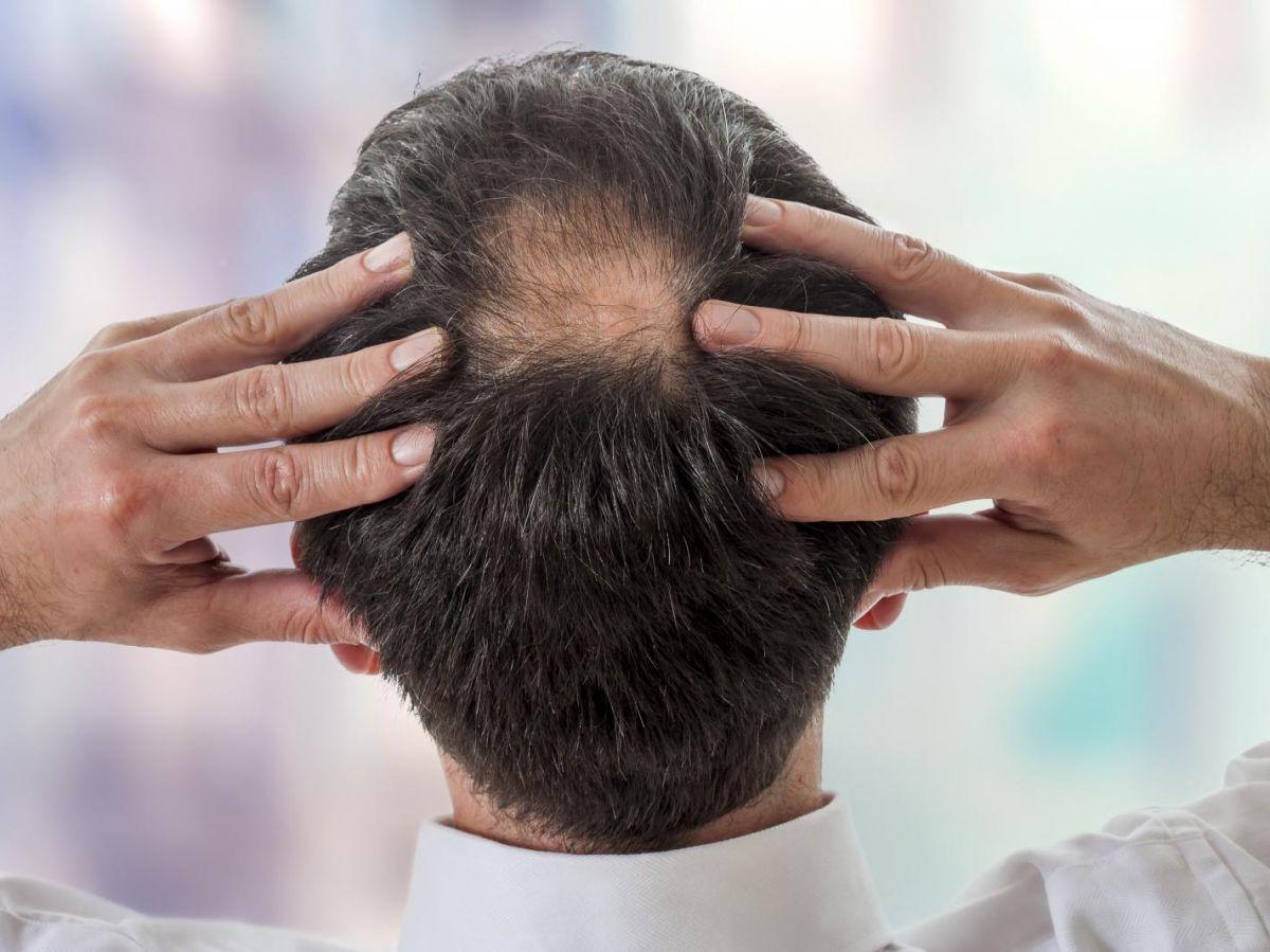 La calvitie serait un problème de rigidité cellulaire mais des chercheurs ont déjà trouvé une solution La calvitie serait un problème de rigidité cellulaire mais des chercheurs ont déjà trouvé une solution