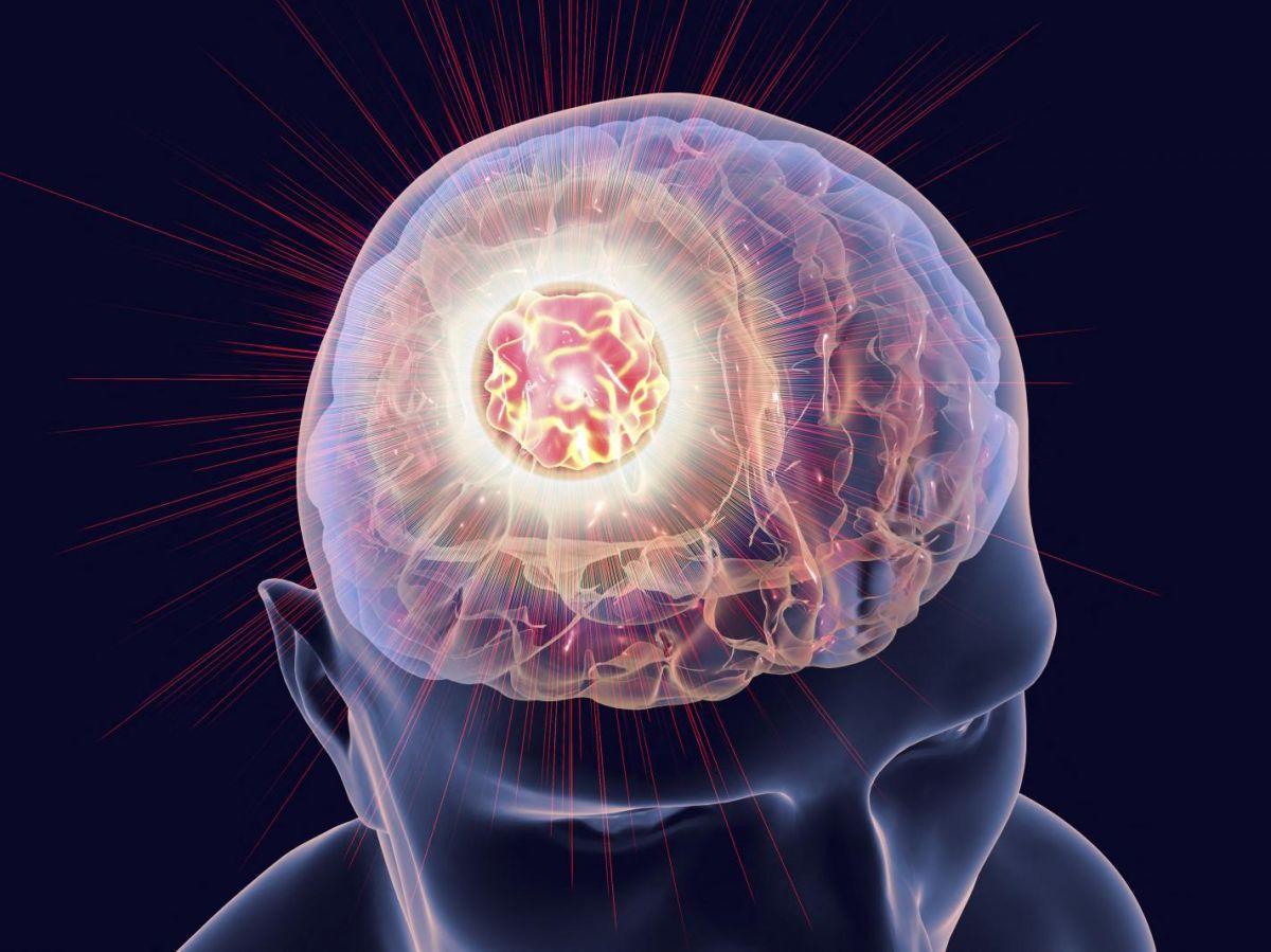 Cancer du cerveau : une percée contre une forme rare et incurable du gliome Cancer du cerveau : une percée contre une forme rare et incurable du gliome