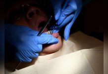 Caries Dentaires vers le Remboursement de Quatre Traitements Caries Dentaires vers le Remboursement de Quatre Traitements