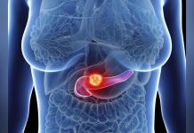 Cancer du Pancréas Éliminé chez la Souris Cancer du Pancréas Éliminé chez la Souris