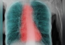 Facteurs Déterminants de la BPCO chez les Fumeurs Facteurs Déterminants de la BPCO chez les Fumeurs