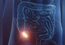 Efficacité des Antibiotiques pour Traiter L’Appendicite Efficacité des Antibiotiques pour Traiter L’Appendicite