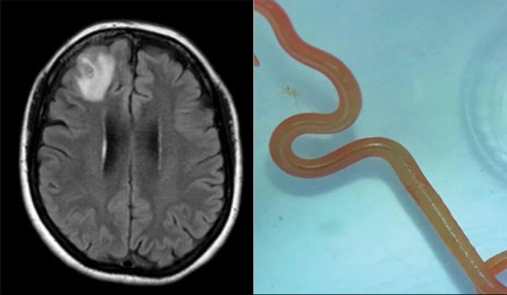 Live worm found in Australian woman’s brain in world first Live worm found in Australian woman’s brain in world first