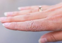 أسباب جفاف اليدين وكيفية علاجها أسباب جفاف اليدين وكيفية علاجها