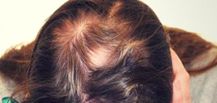 تعرفي على أسباب مرض ثعلبة الشعر تعرفي على أسباب مرض ثعلبة الشعر
