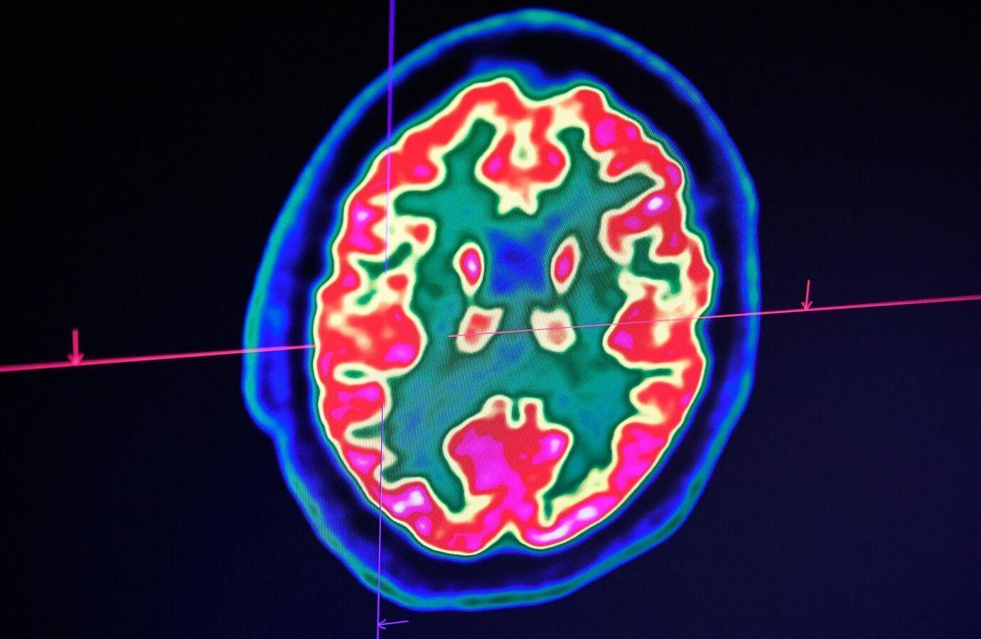 دراسة: تغيرات الدماغ مرتبطة بـ”الدخل المنخفض وخيارات الطعام السيئة” دراسة: تغيرات الدماغ مرتبطة بـ”الدخل المنخفض وخيارات الطعام السيئة”