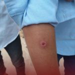 اكتشاف حالات إصابة باللشمانيا بين طلاب المدارس في ترهونة اكتشاف حالات إصابة باللشمانيا بين طلاب المدارس في ترهونة