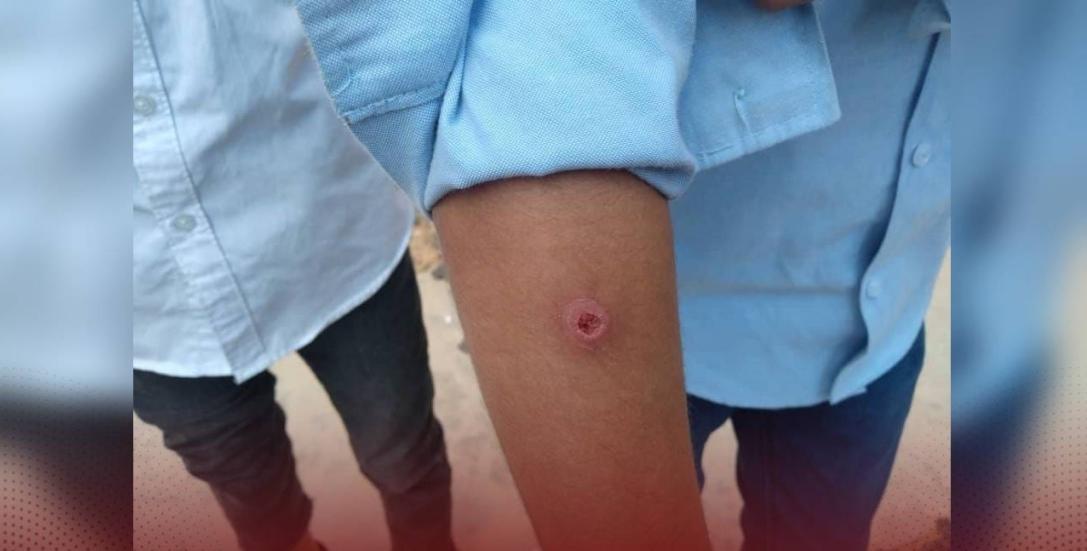 اكتشاف حالات إصابة باللشمانيا بين طلاب المدارس في ترهونة