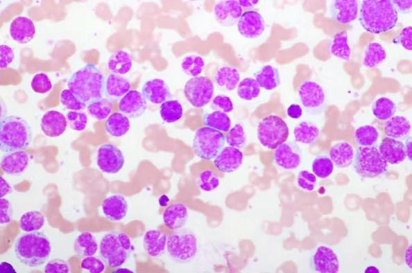 Cancer : les thérapies de différenciation, ou comment faire revenir les cellules cancéreuses dans le droit chemin Cancer : les thérapies de différenciation, ou comment faire revenir les cellules cancéreuses dans le droit chemin