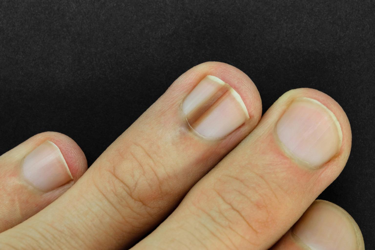 Cancer de la peau : surveillez aussi vos ongles Cancer de la peau : surveillez aussi vos ongles