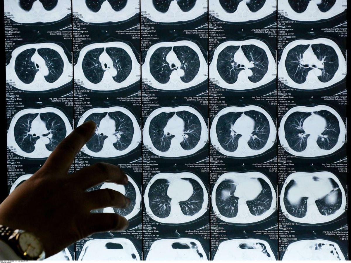 ASCO 2023. Cancer du poumon : un traitement réduit significativement le risque de décès ASCO 2023. Cancer du poumon : un traitement réduit significativement le risque de décès