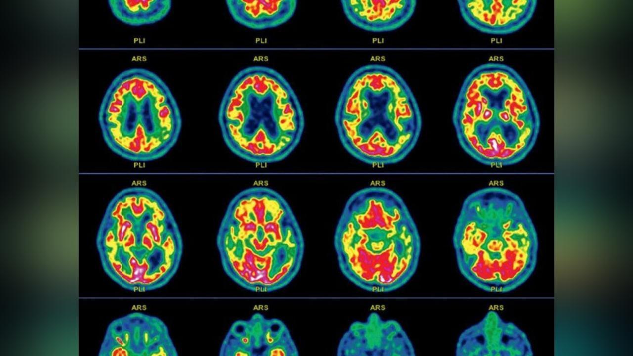 L’amnésie, un Trouble aux Multiples Causes L’amnésie, un Trouble aux Multiples Causes