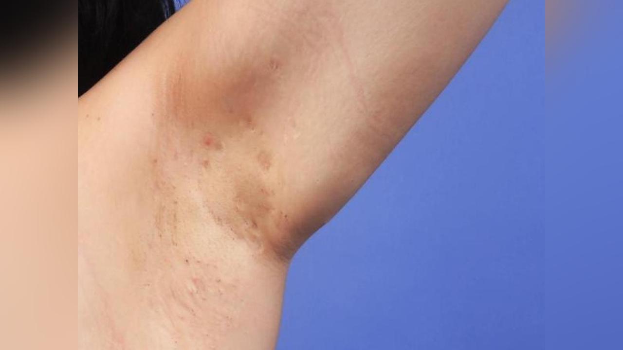 Maladie de Verneuil: 1 % de la Population Est Atteinte Maladie de Verneuil: 1 % de la Population Est Atteinte