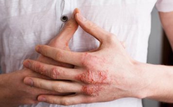 Eczéma: Fréquence de Lavage N’Affecte pas les SymptôMes Eczéma: Fréquence de Lavage N’Affecte pas les SymptôMes