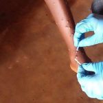 Mpox: 76 Cas Détectés, 7 Régions Touchées Mpox: 76 Cas Détectés, 7 Régions Touchées