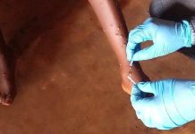 Mpox: 76 Cas Détectés, 7 Régions Touchées Mpox: 76 Cas Détectés, 7 Régions Touchées