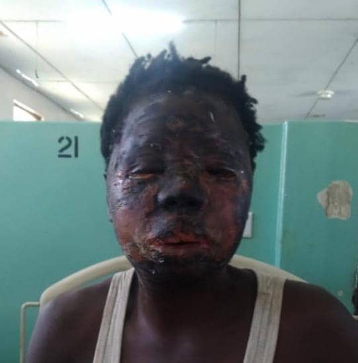 Mangochi fisherman Missi Bwanali arrested for dousing wife with hot water Mangochi fisherman Missi Bwanali arrested for dousing wife with hot water