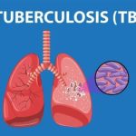 Communities Urged to Dispel TB Myths to Improve Treatment Communities Urged to Dispel TB Myths to Improve Treatment