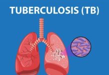 Communities Urged to Dispel TB Myths to Improve Treatment Communities Urged to Dispel TB Myths to Improve Treatment