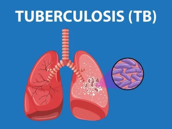 Communities Urged to Dispel TB Myths to Improve Treatment Communities Urged to Dispel TB Myths to Improve Treatment