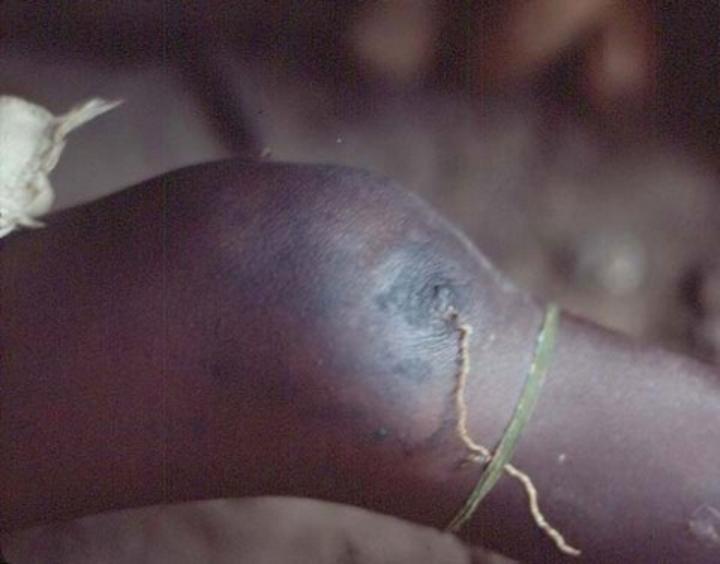 Ver de Guinée : Le Mali déterminé définitivement à éradiquer la maladie Ver de Guinée : Le Mali déterminé définitivement à éradiquer la maladie