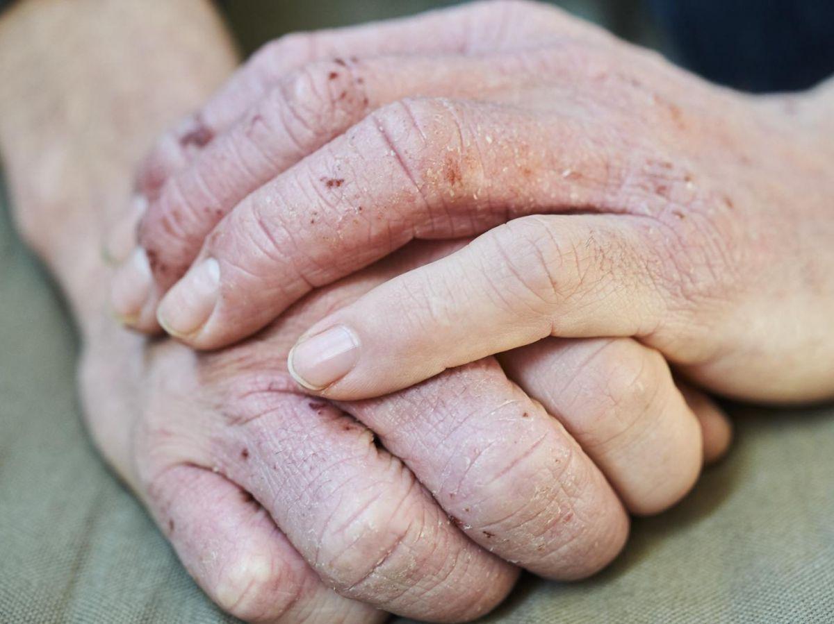 Eczéma : ces bactéries seraient particulièrement abondantes chez les patients atteints Eczéma : ces bactéries seraient particulièrement abondantes chez les patients atteints