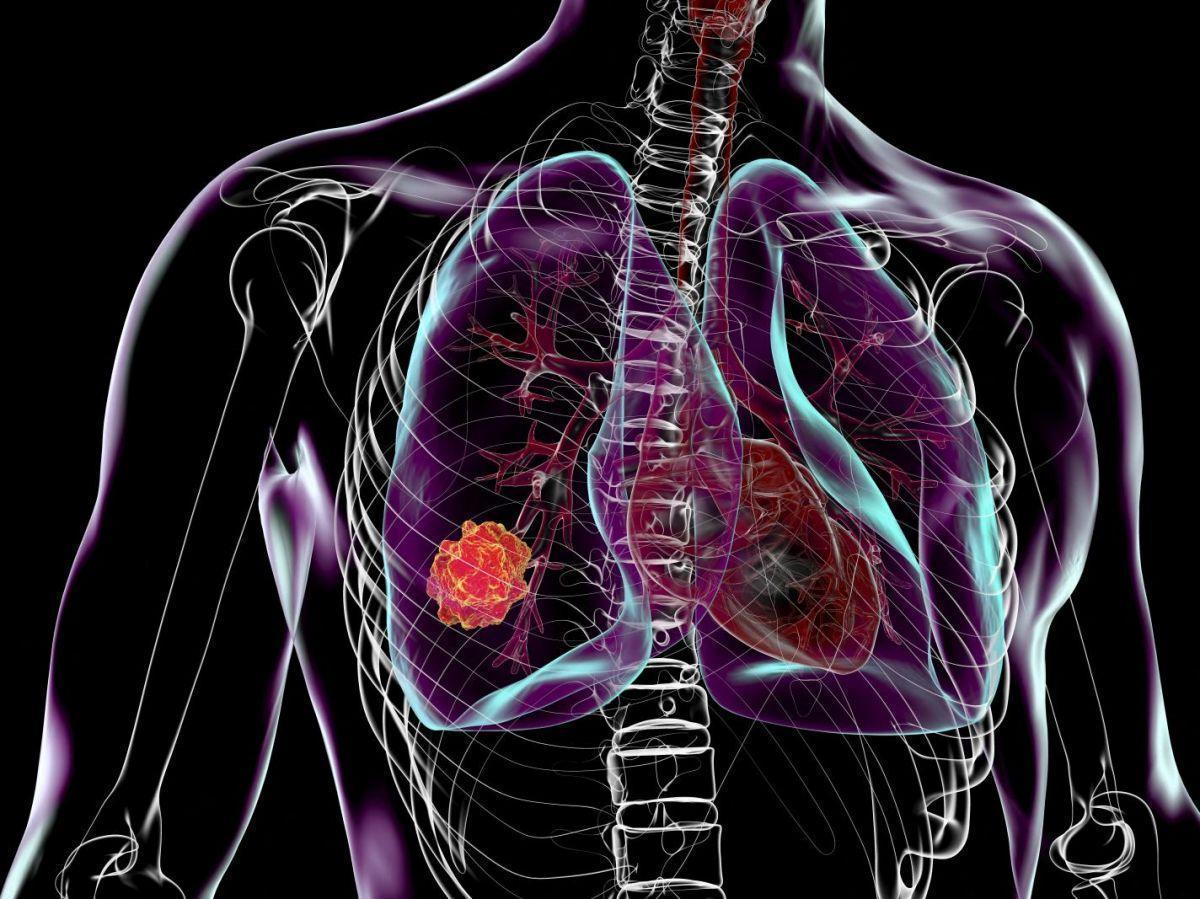 Cancer du poumon : des avancées considérables annoncées lors du congrès international à Chicago (ASCO) Cancer du poumon : des avancées considérables annoncées lors du congrès international à Chicago (ASCO)