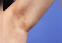 Maladie de Verneuil: 1 % de la Population Touchée Maladie de Verneuil: 1 % de la Population Touchée