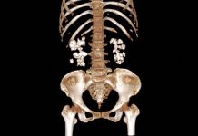 Découverte Inattendue sur les Calculs Rénaux Découverte Inattendue sur les Calculs Rénaux