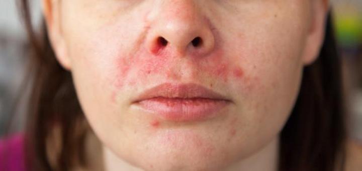 أعراض حساسية الهستامين أعراض حساسية الهستامين